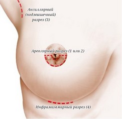 Шрамы после увеличения груди