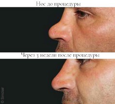 Инъекции для коррекции формы носа - фото до и после Ellanse- фотографии пациента до и после коррекции носа