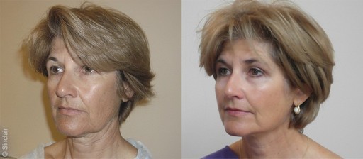 Результат после нитевой подтяжки Silhouette Soft Silhouette Soft, результат и фотографии