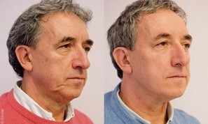 Показания для нитевого лифтинга Silhouette Soft Результат нитевого лифтинга, фото