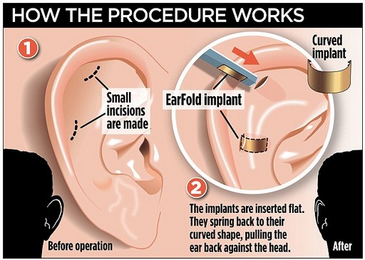 Импланты earFold ™ в Париже Пластинки earFold ™ для коррекции формы ушей без хирургии