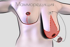 Операция для уменьшение груди