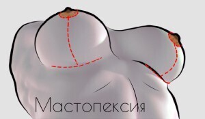 Мастопексия, операция по подтяжке груди Исправить форму груди, подтянуть обвисшую грудь, Париж